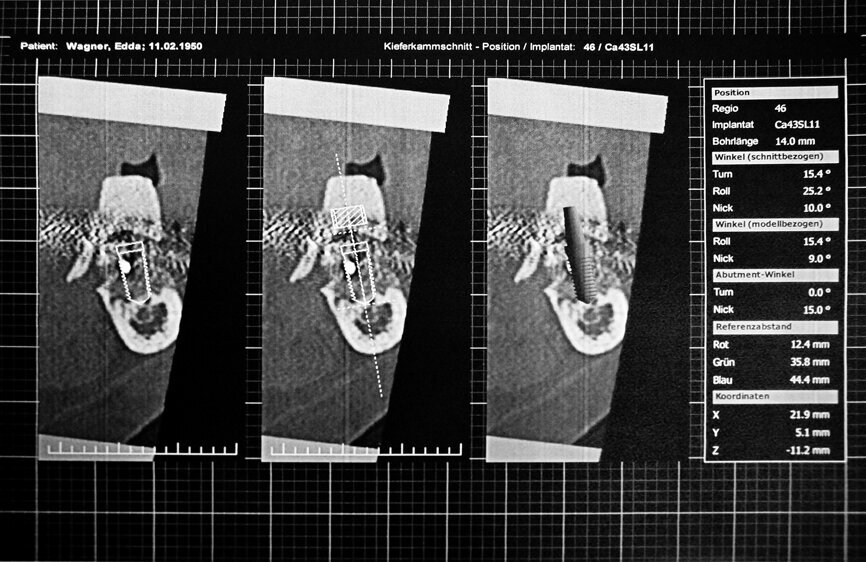 Fig. 3 : Coupe sagittale au niveau du site implantaire 46 planifié.