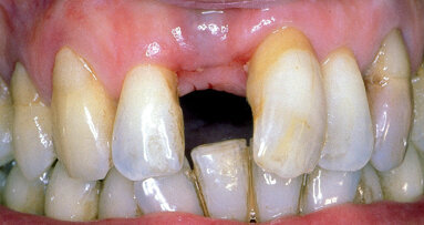Triumfy a tragédie v implantologii