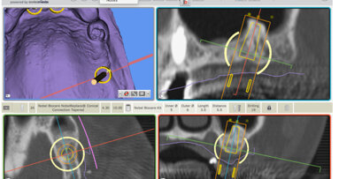 La chirurgie guidée pour optimiser l’implantologie