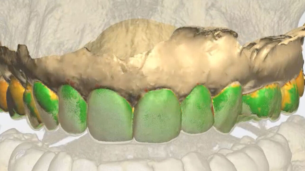 Elemento singolo in implantoprotesi in area estetica: proposta di protocollo clinico semplificato