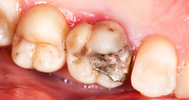 Amalgamverbot negativ für Gesundheitskosten