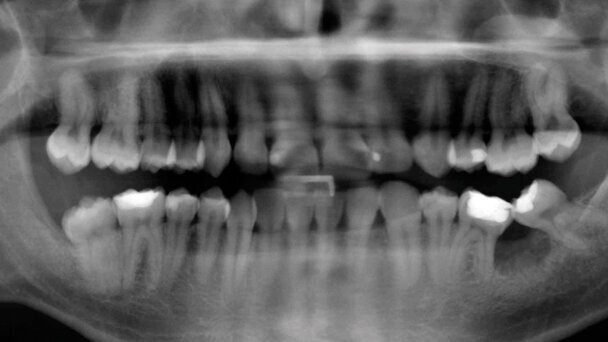 L’utilizzo  della corticotomia e delle miniscrew nel trattamento del paziente adulto. Case report