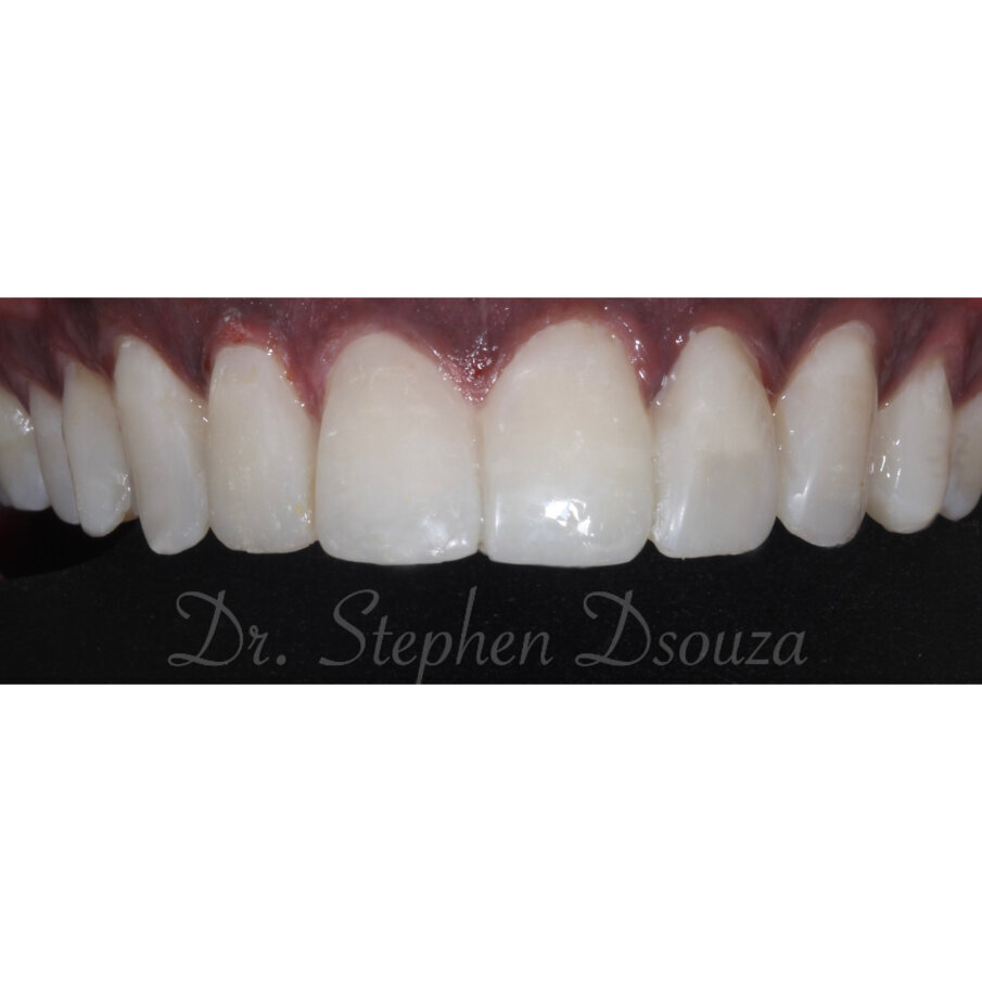 Fig. 8 Post-operative, retracted view