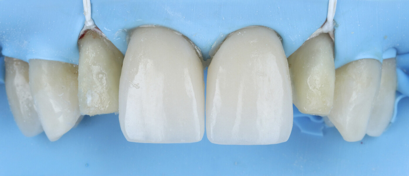 Fig. 20a: Use of dental floss to aid gingival retraction during clampless placement of the lateral incisor veneers. 