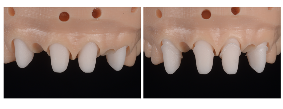 Figg. 25a, b_ Modello stampato con condizionamento tissutale e monconi sfilabili.