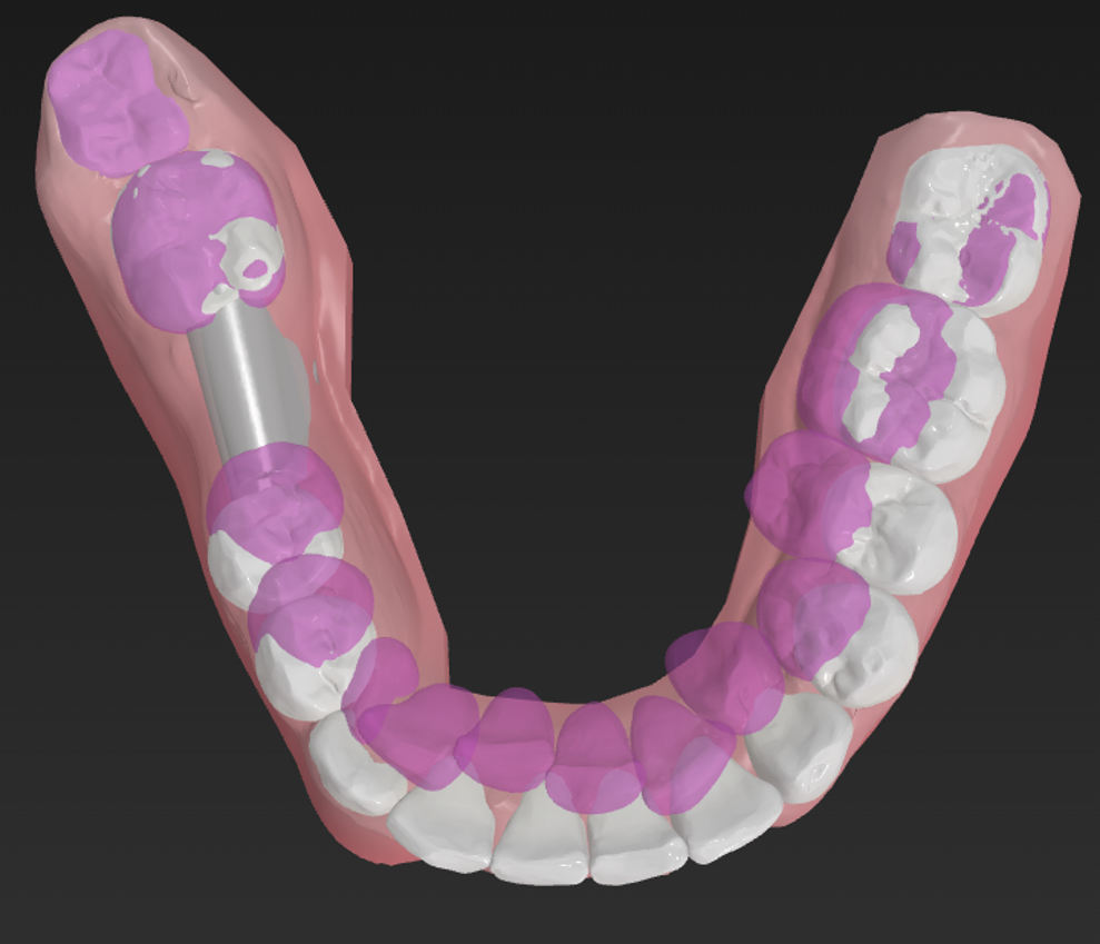Overlay of the initial tooth position (purple) and the proposed digital treatment setup (white). In this case, the automated treatment proposal suggests movements that exceed realistic biological limits, illustrating why digital setups require careful clinical interpretation. (Image: Dr Jesper Hatt) 