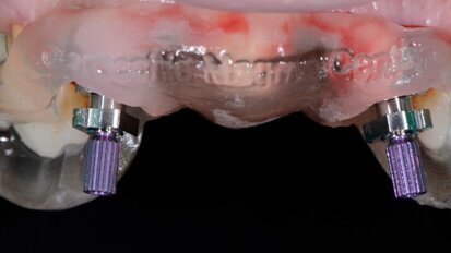 Flusso digitale e provvisorio post-chirurgico: nuova procedura clinica per il carico immediato