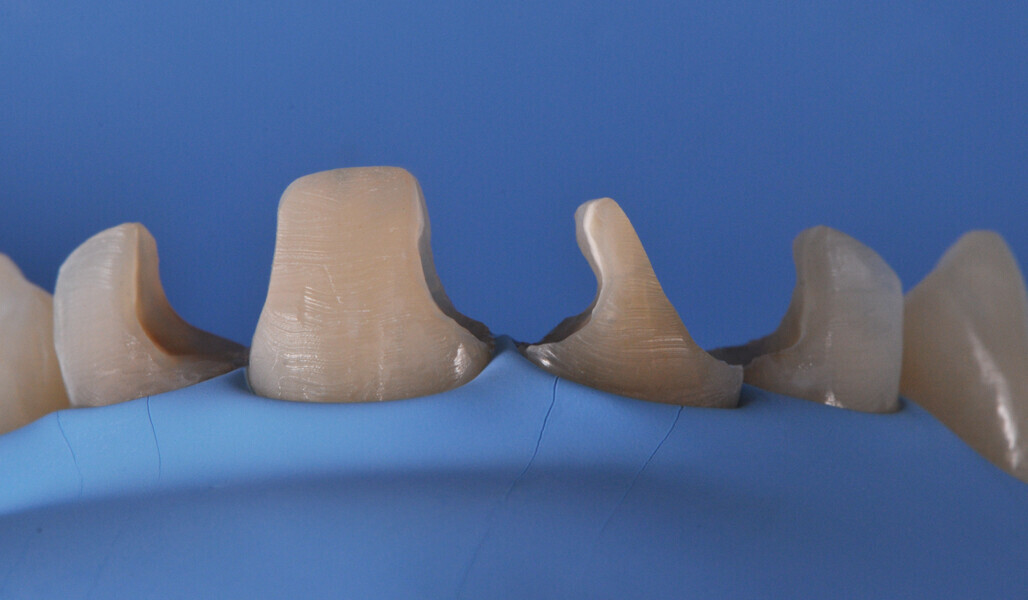 Fig. 8: Existing restorations removed and tooth surfaces roughened at the start of treatment.