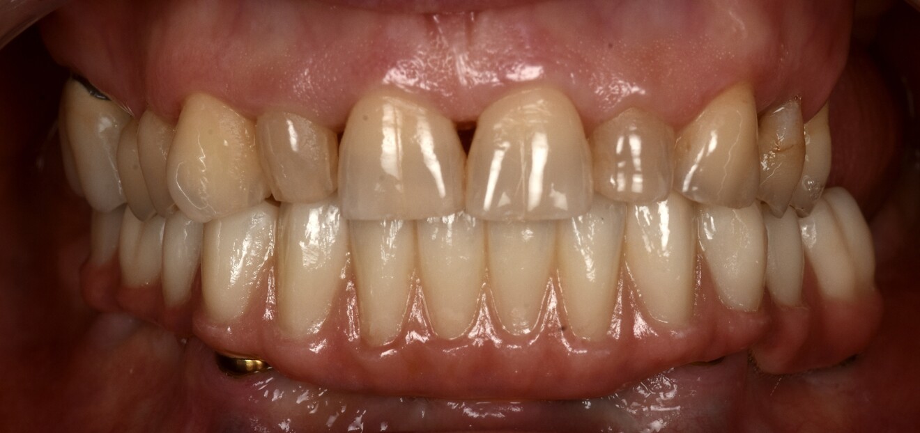Fig. 16e: Final intra-oral view.