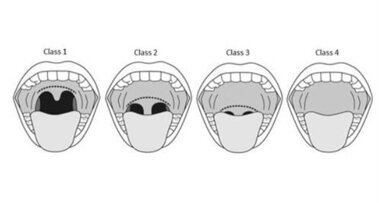 Trattamento dei disturbi del sonno con Laser Er:YAG Fotona