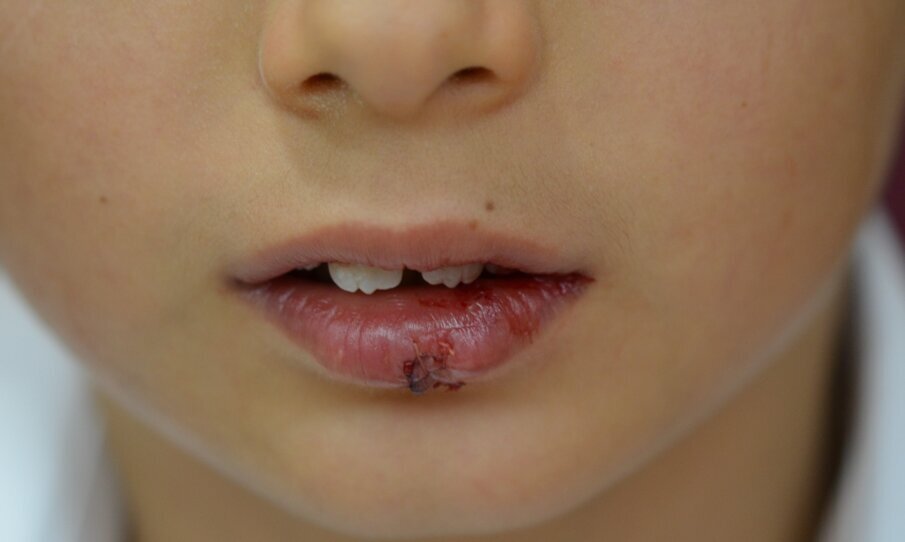 Figure 9. Immediate post suturing. Notice the wound margins had been aligned so the  vermilion was continuous.