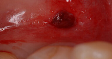Accelerated generation of human induced pluripotent stem cells from human oral mucosa using episomal plasmid vectors and maternal transcription factor Glis1