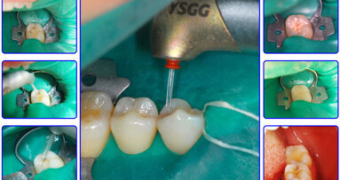 Láser en Odontología Conservadora (8)