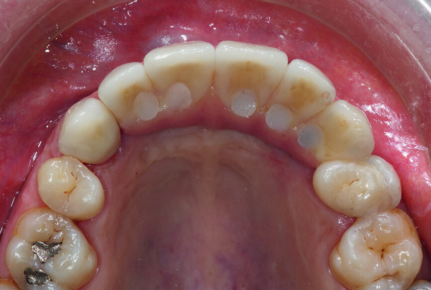 Fig. 37: Installation of the final prosthesis and verification of
correct occlusion. Screw channels filled with composite.