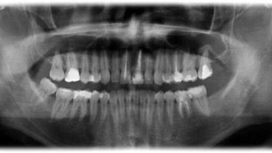 Leczenie endodontyczne autogennego przeszczepu zęba z zastosowaniem lasera Er,Cr:YSGG