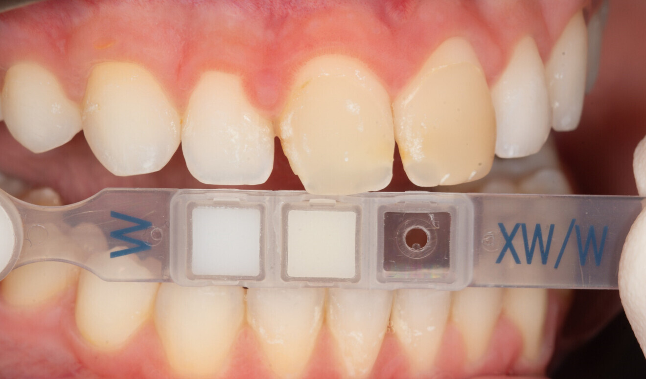Fig.5 a : Teintier Clearfil Majesty ES-2.
