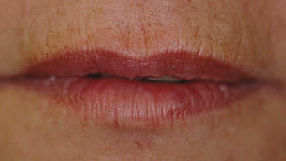 Take a cosmetic practice to the next level with facial injectables Take a cosmetic practice to the next level with facial injectables