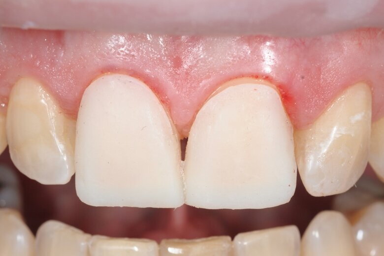 Fig. 10 Finished temporary veneers.