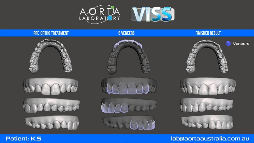 Fig. 48: Simulated VISS images showing the situation pretreatment and post-treatment with six veneers superimposed (purple) and the final result.
