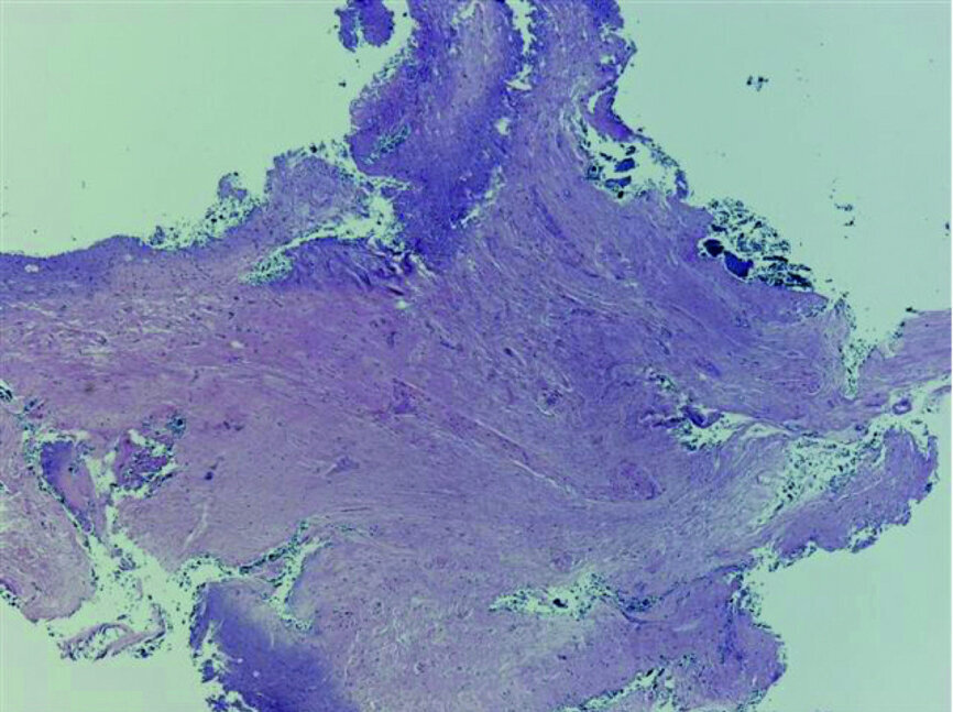 Fig. 21: Tissue removed from the endodontic space three months after transplantation (H&E stain; 4× magnification).