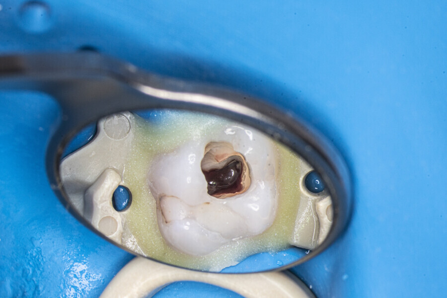 Fig. 39: The maxillary first molar after creation of the access cavity.