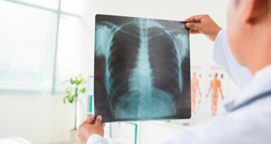 Il trattamento della carie può prevenire la polmonite nei pazienti affetti dal Parkinson