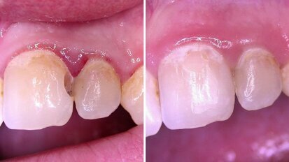 Webinar: Flexible Response in der Parodontaltherapie Webinar: Flexible Response in der Parodontaltherapie