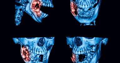 Odontogenic keratocysts going undiagnosed for too long, study finds