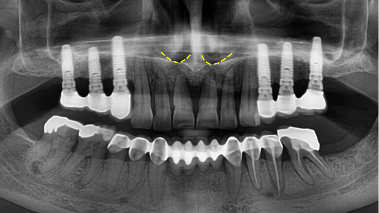 Kdy parodontolog předá pacienta implantologovi?