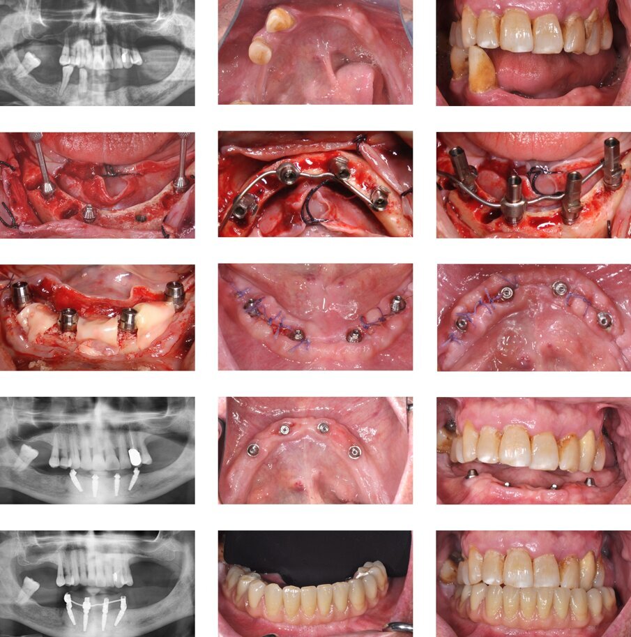 Fig. 3 - Un caso illustrativo dell’impiego della tecnica OkSplint. Un paziente, con alcuni elementi compromessi nell’arcata inferiore, viene sottoposto ad estrazione e riabilitazione dell’arcata ora edentula attraverso l’inserimento di quattro impianti osteointegrati, secondo l’approccio “All-on-four”. Gli abutment sono splintati attraverso la tecnica OkSplint per realizzare una protesi tipo Toronto-Branemark. 