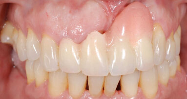 Gestion des tissus mous en cas de mauvais positionnement de l'implant dans la zone esthétique