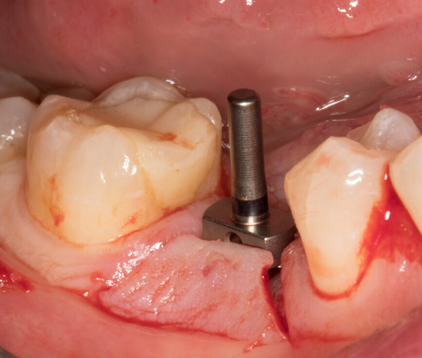 Ryc. 7 i 8_Osadzenie znacznika celem potwierdzenia pozycji przyszłego wszczepu.