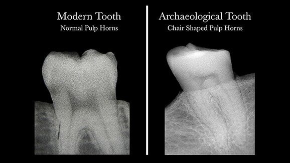 Scientists discover that dental radiographs can reveal vitamin D deficiency