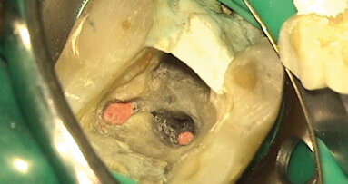 Résultats du sondage sur les systèmes d'obturation canalaire à chaud