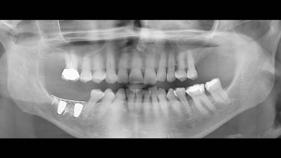 Figg. 8a, 8b_OPT e sezioni di CBCT dopo l’intervento che mostrano l’incremento osseo ottenuto.