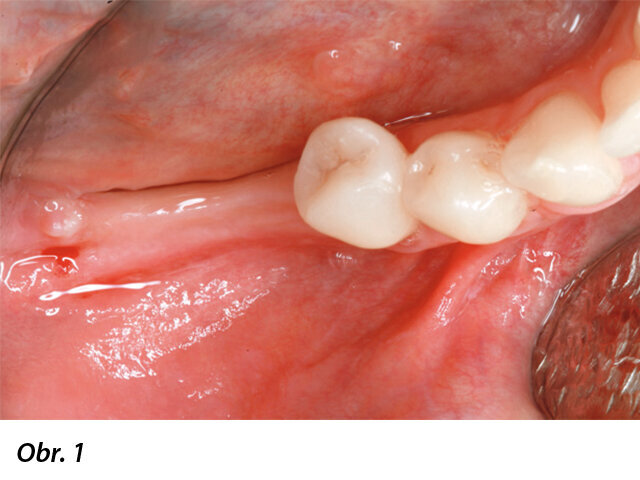 Okluzální pohled na silně atrofovaný hřeben v distální části dolní čelisti.