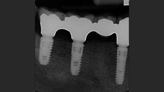 Open-cohort prospective study on early implant failure and physiological marginal remodeling expected using sandblasted and acid-etched bone level implants featuring an 11° Morse taper connection within one year after loading