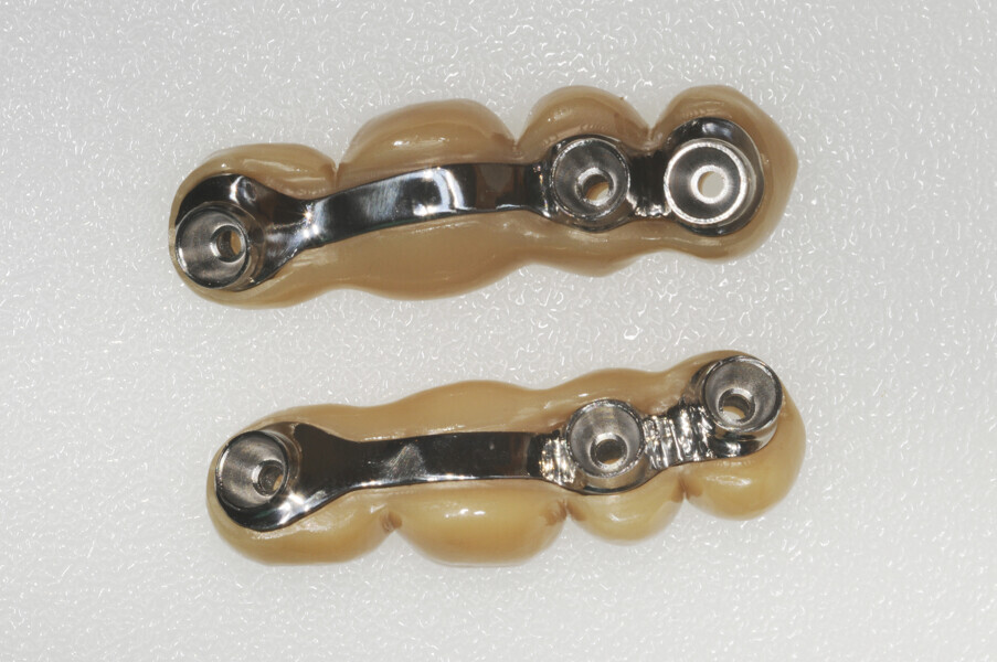 Fig. 15: Zirconia shells cemented extra-orally on to the Atlantis BridgeBase frameworks.