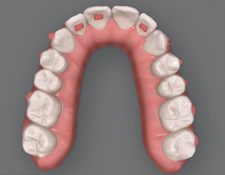 Fig. 5a : Plan supplémentaire du traitement par aligneurs conçu par ClinCheck (début). 