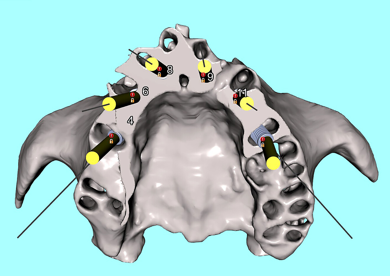 Fig. 4c: Occlusal view of the simulated extractions and implants in the maxillary arch.