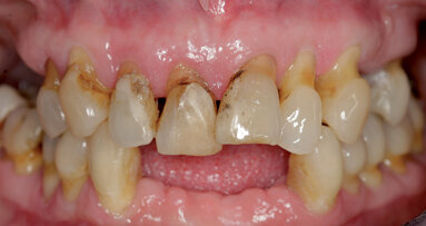 Zubní implantáty – od týmového plánování k esteticky úspěšnému výsledku