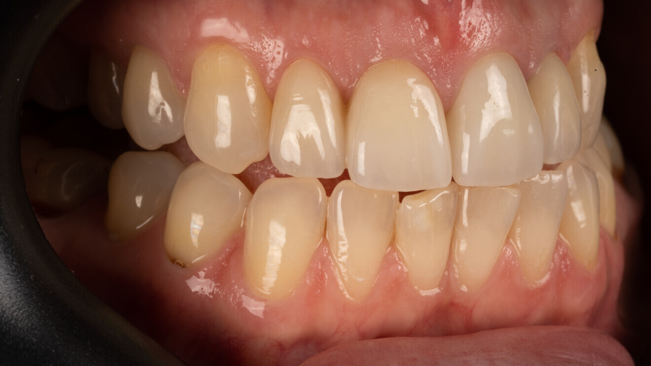 Fig. 6: Final treatment outcome.  