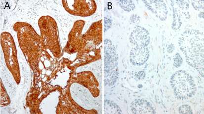 Découverte d’une mutation dans une tumeur de la mâchoire