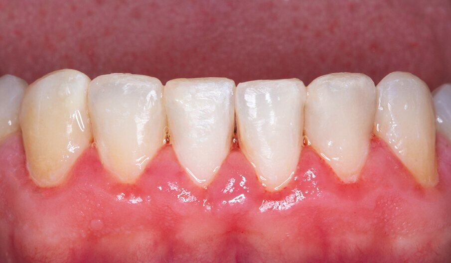 Fig. 6: Final situation after dental dam removal.