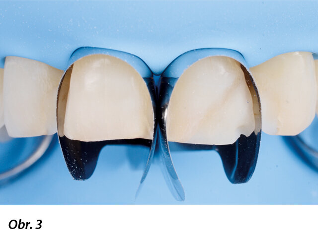 Matrice Unica Anterior umístěné na oba střední řezáky.