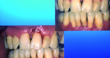 Die 2-Schritt-Therapie bei schwerer Parodontitis