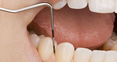 Paradontozę trzeba leczyć!