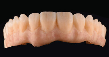 Micro‑layering for implant‑supported zirconia prostheses