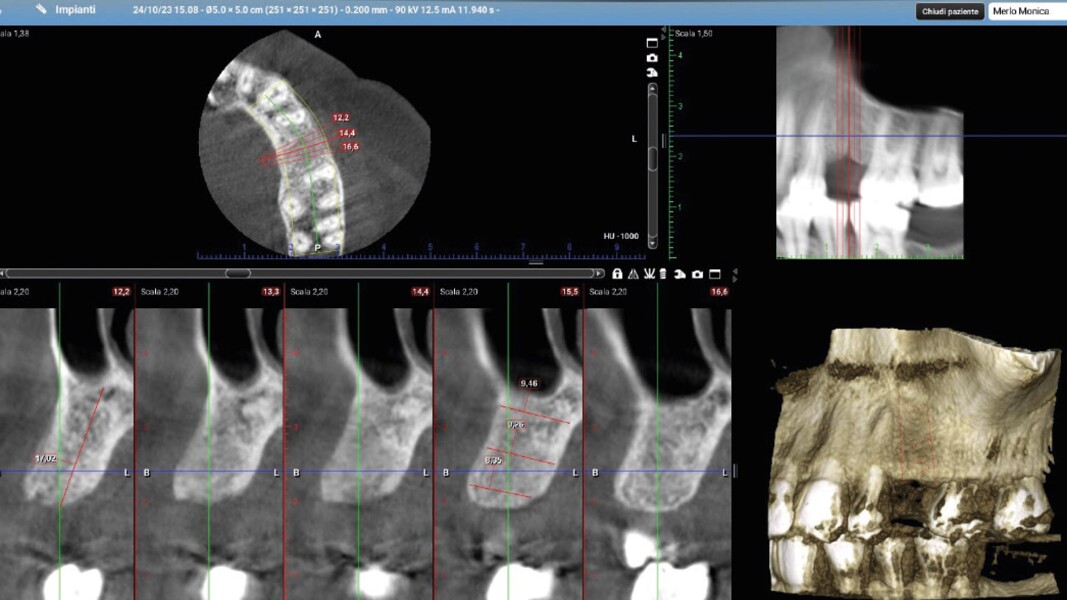 Fig. 12_CBCT T1.