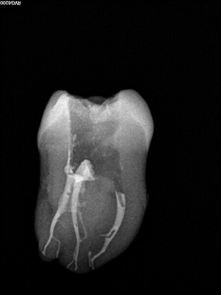 Fig. 6: Post-op radiograph of a maxillary molar.